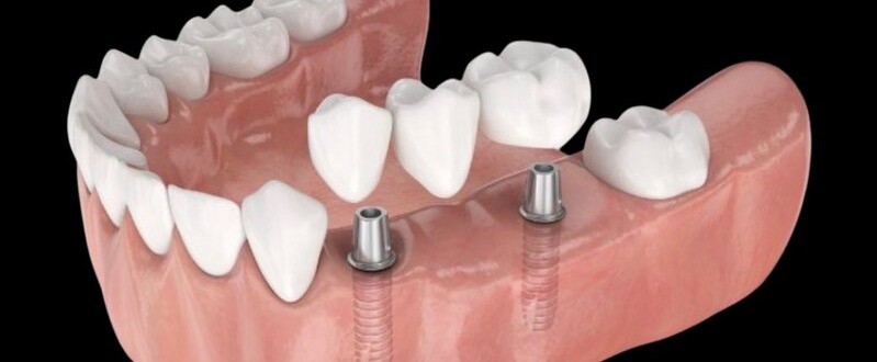 Caso clínico de implante dental con corona atornillada