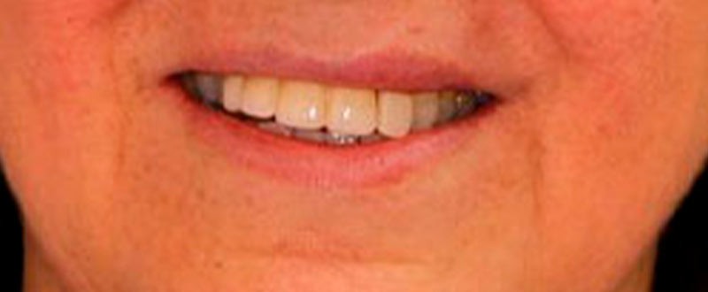 Caso clínico de prótesis fija plural: puente dental de cerámica