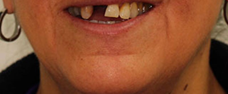 Caso clínico de prótesis fija plural: puente dental terminado