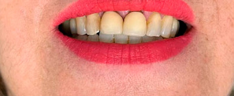 Caso clínico de prótesis fija unitaria: corona dental sobre pieza restaurada