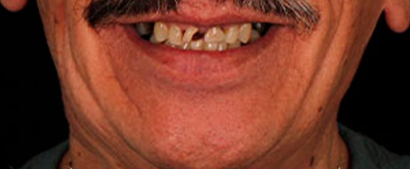 Caso clínico de prótesis fija unitaria: corona dental de cerámica