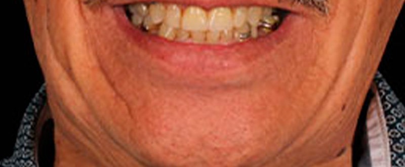 Caso clínico de prótesis fija unitaria: corona dental instalada