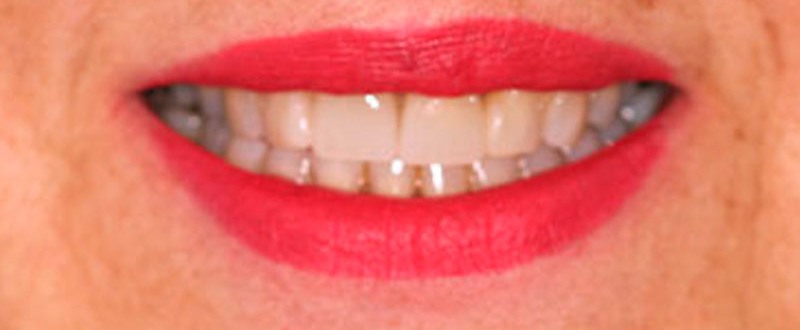 Caso clínico de prótesis fija unitaria: corona dental terminada