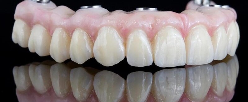 Caso clínico de prótesis híbrida fija sobre implantes